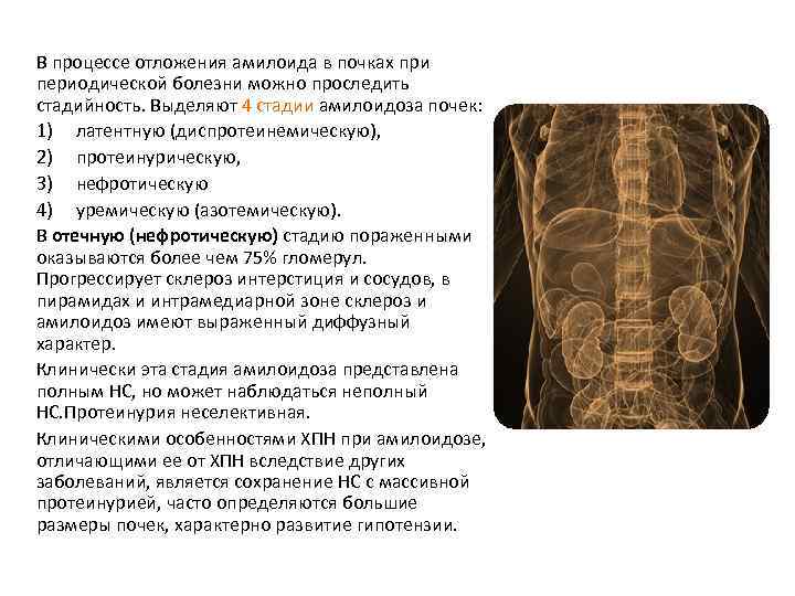 В процессе отложения амилоида в почках при периодической болезни можно проследить стадийность. Выделяют 4