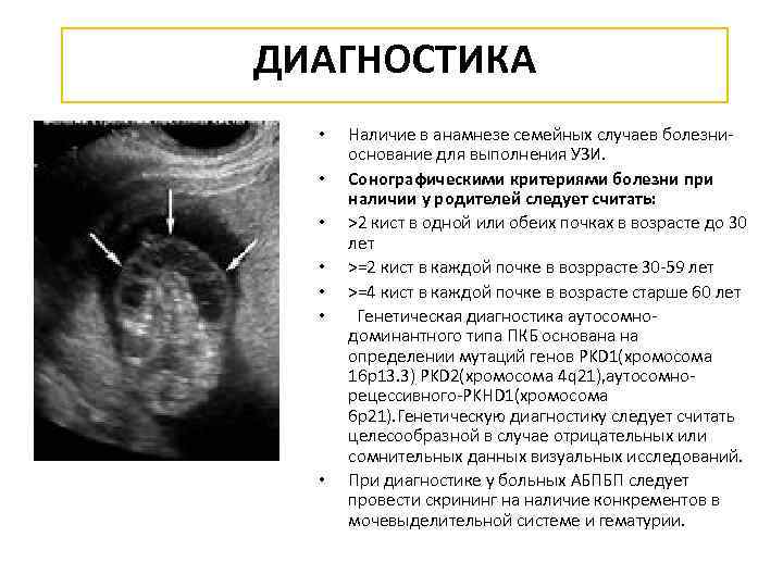 ДИАГНОСТИКА • • Наличие в анамнезе семейных случаев болезниоснование для выполнения УЗИ. Сонографическими критериями