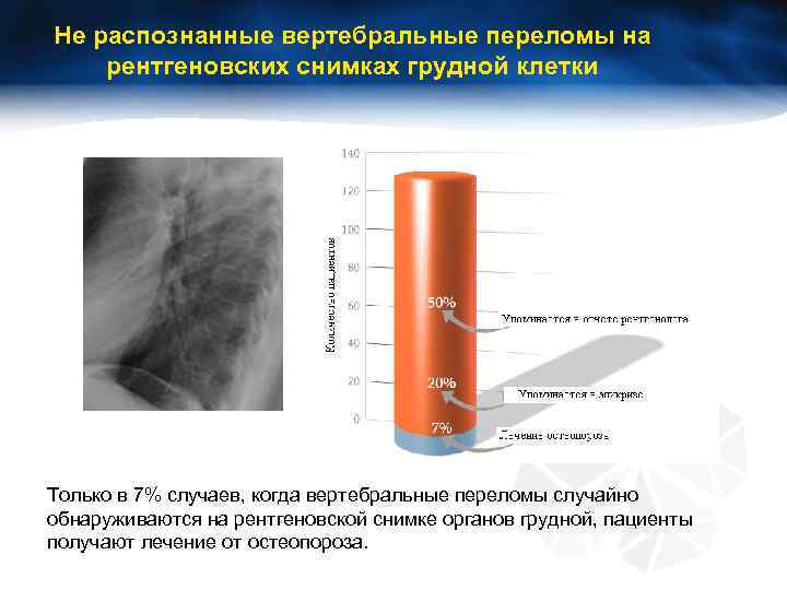 Не распознанные вертебральные переломы на рентгеновских снимках грудной клетки Только в 7% случаев, когда