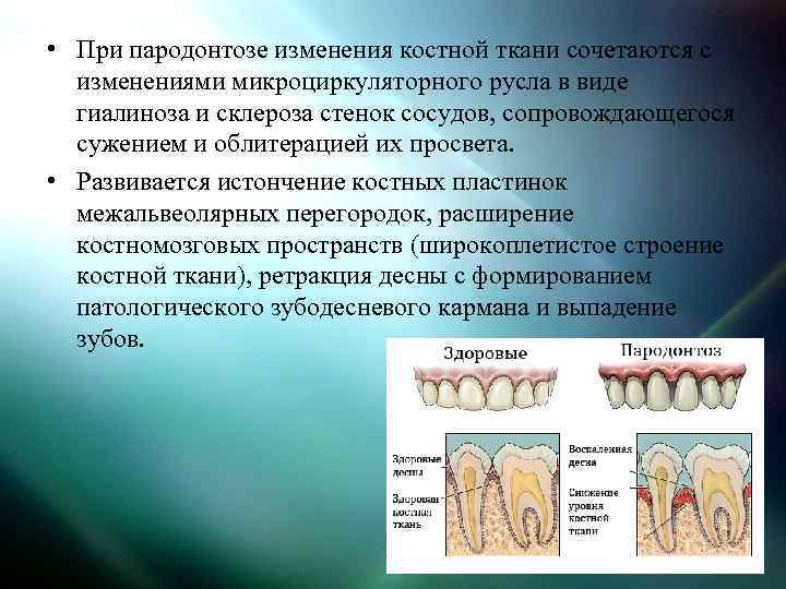  • При пародонтозе изменения костной ткани сочетаются с изменениями микроциркуляторного русла в виде