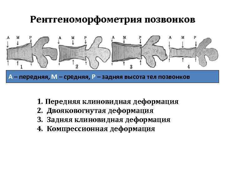 Позвоночник деформирован. Двояковогнутая деформация позвонков. Клиновидная деформация тела позвонка рентген. Клиновидные компрессионные переломы тел позвонков. Степень клиновидной деформации тела позвонка.