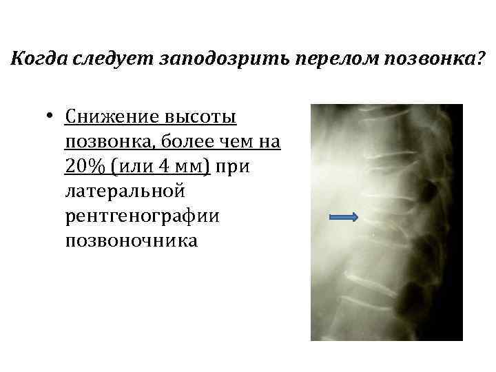 Остеопороз перелом позвоночника. Клиновидная деформация позвонков 1 степени. Снижена высота тела позвонка остеопороз. Снижение высоты тела позвонка. Снижение высоты позвонка рентген.