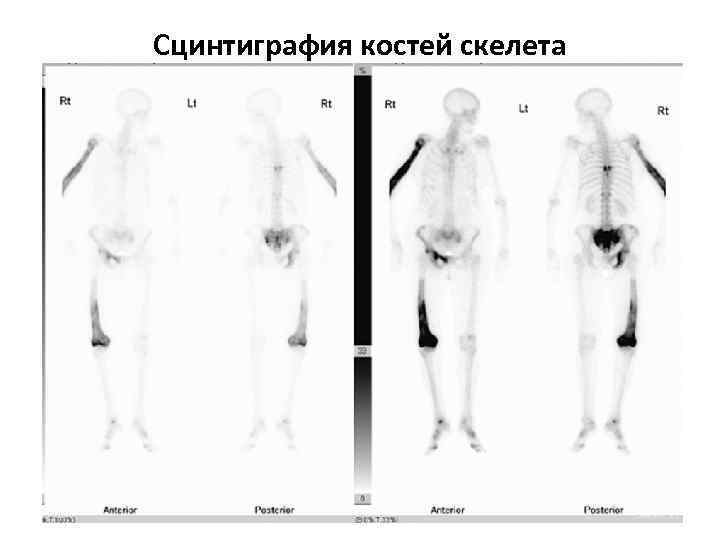 Сцинтиграфия костей скелета. Болезнь Педжета остеосцинтиграфия. Болезнь Педжета сцинтиграфия. Сцинтиграфия костей при болезни Педжета. Болезнь Педжета на сцинтиграфии.