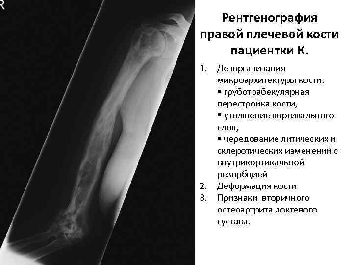 Рентгенография правой плечевой кости пациентки К. 1. Дезорганизация микроархитектуры кости: § груботрабекулярная перестройка кости,