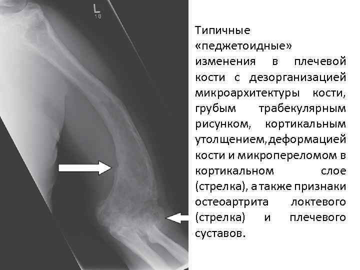 Трабекулярный отек