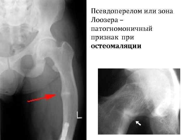 Для разгара рахита характерна следующая рентгенологическая картина