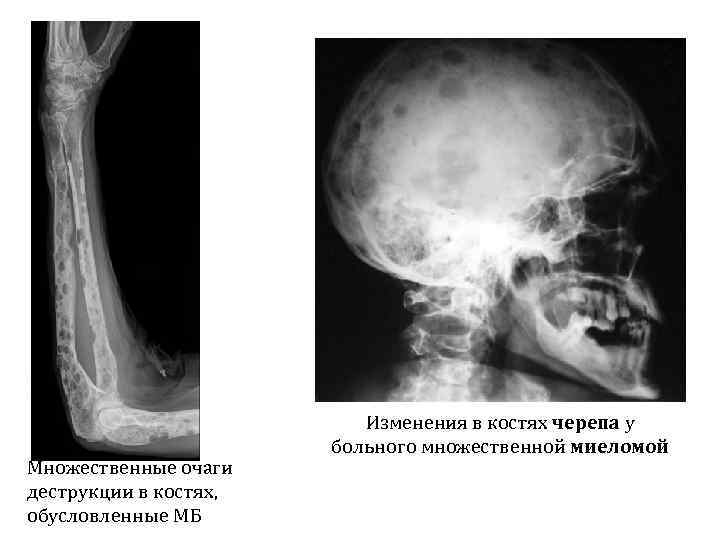 Для рентгенологической картины фолликулярной кисты характерна деструкция костной ткани в виде