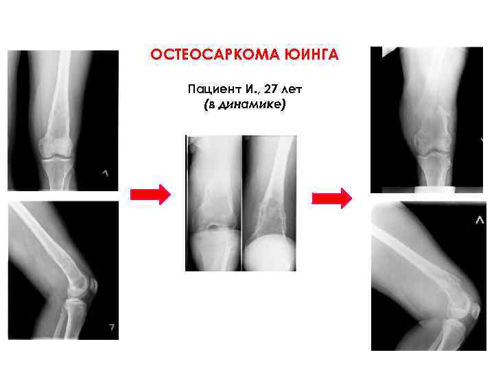 ОСТЕОСАРКОМА ЮИНГА Пациент И. , 27 лет (в динамике) 