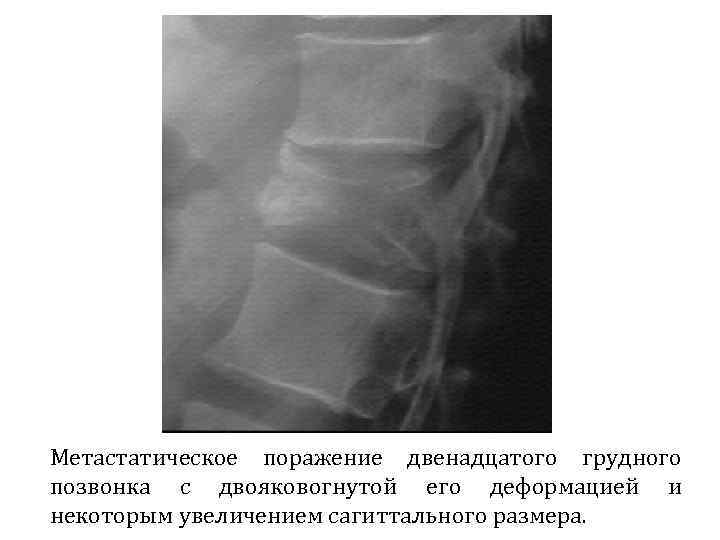 Метастатическое поражение двенадцатого грудного позвонка с двояковогнутой его деформацией и некоторым увеличением сагиттального размера.
