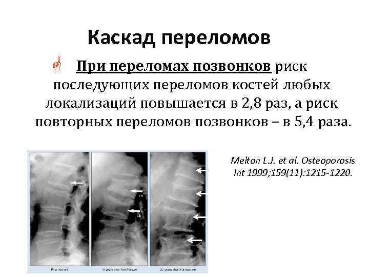 Каскад переломов G При переломах позвонков риск последующих переломов костей любых локализаций повышается в