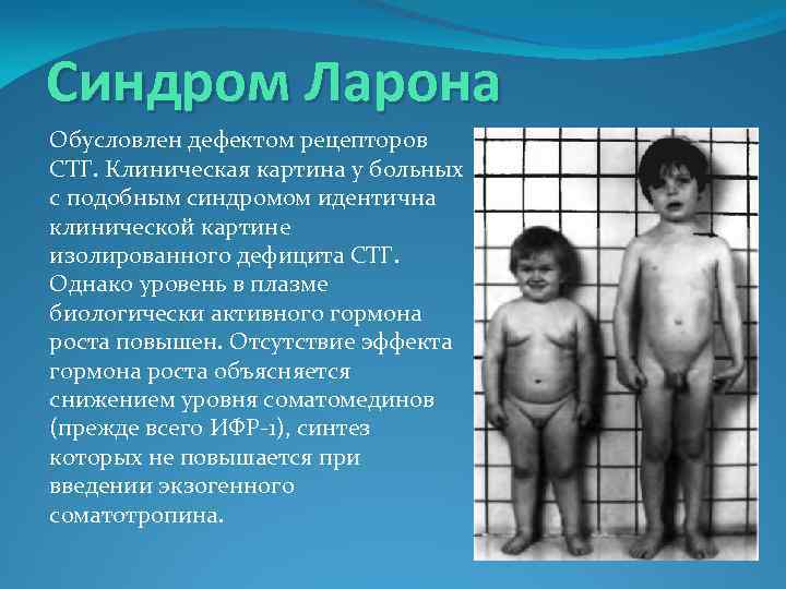 Синдром Ларона Обусловлен дефектом рецепторов СТГ. Клиническая картина у больных с подобным синдромом идентична
