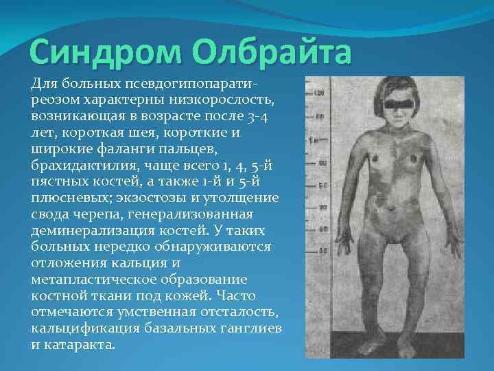 Синдром Олбрайта Для больных псевдогипопаратиреозом характерны низкорослость, возникающая в возрасте после 3 -4 лет,