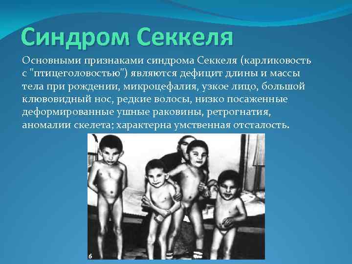 Синдром Секкеля Основными признаками синдрома Секкеля (карликовость с "птицеголовостью") являются дефицит длины и массы