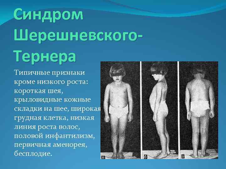 Синдром Шерешневского. Тернера Типичные признаки кроме низкого роста: короткая шея, крыловидные кожные складки на
