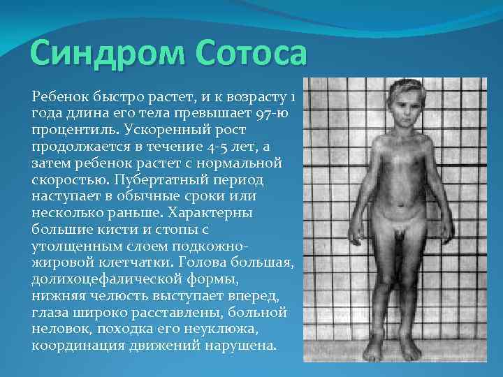 Синдром Сотоса Ребенок быстро растет, и к возрасту 1 года длина его тела превышает