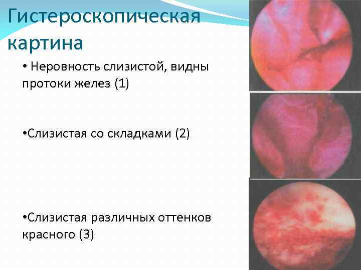 Гистероскопическая картина • Неровность слизистой, видны протоки желез (1) • Слизистая со складками (2)