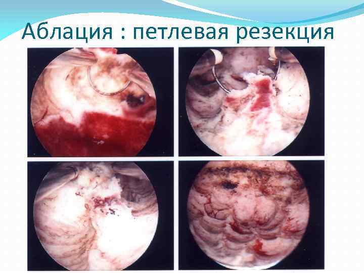 Аблация : петлевая резекция 