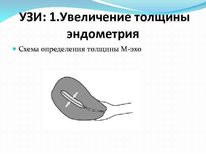 УЗИ: 1. Увеличение толщины эндометрия Схема определения толщины М-эхо 