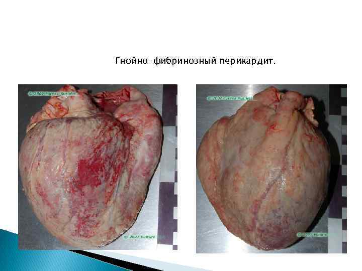 Гнойно-фибринозный перикардит. 