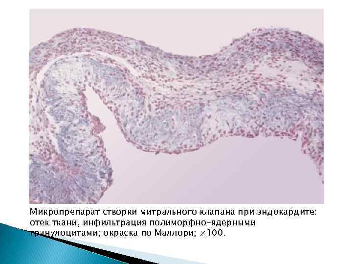 Сегменты створок митрального клапана