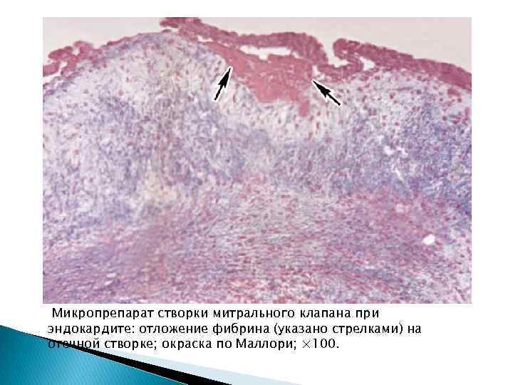  Микропрепарат створки митрального клапана при эндокардите: отложение фибрина (указано стрелками) на отечной створке;