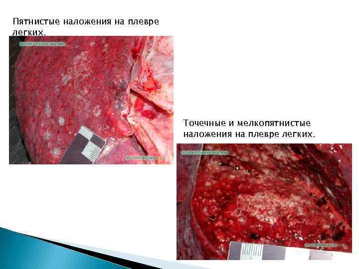 Пятнистые наложения на плевре легких. Точечные и мелкопятнистые наложения на плевре легких. 