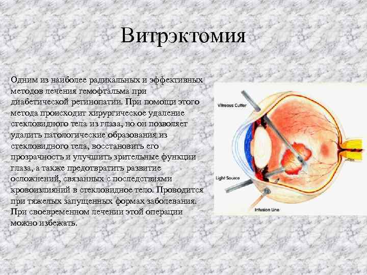 Витрэктомия Одним из наиболее радикальных и эффективных методов лечения гемофтальма при диабетической ретинопатии. При