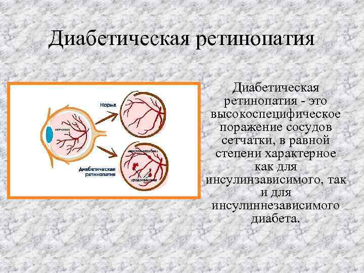 Осложнения диабетической ретинопатии