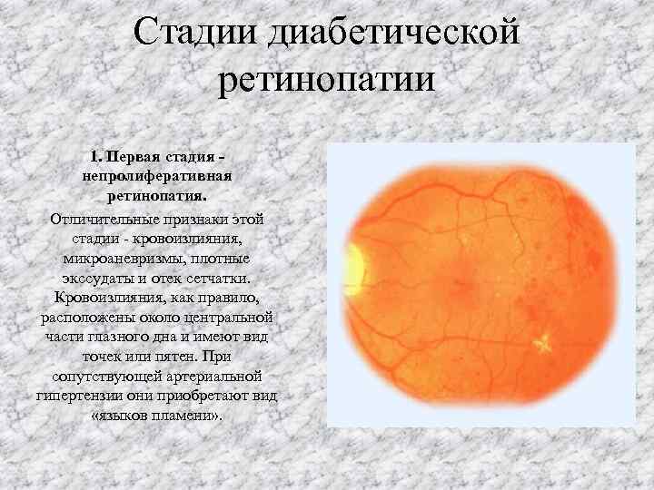 Изменение глазного дна при сахарном диабете презентация