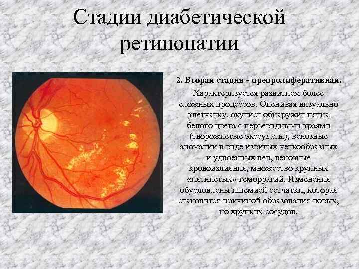 Изменение глазного дна при сахарном диабете презентация