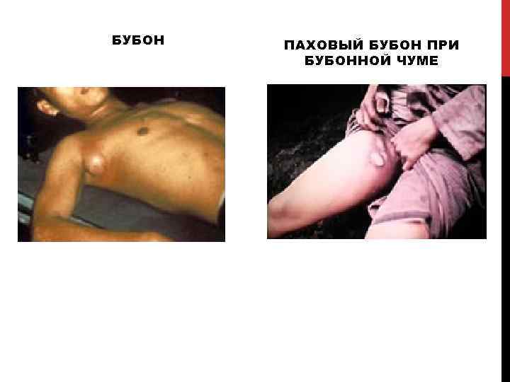 БУБОН ПАХОВЫЙ БУБОН ПРИ БУБОННОЙ ЧУМЕ 