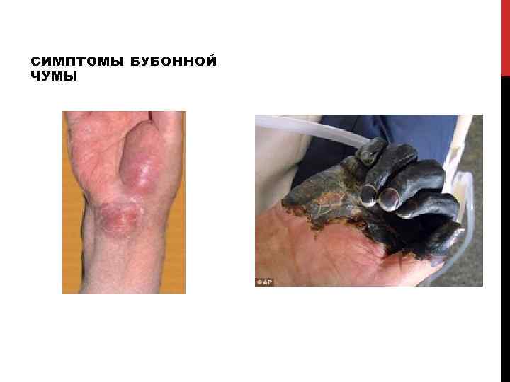 СИМПТОМЫ БУБОННОЙ ЧУМЫ 