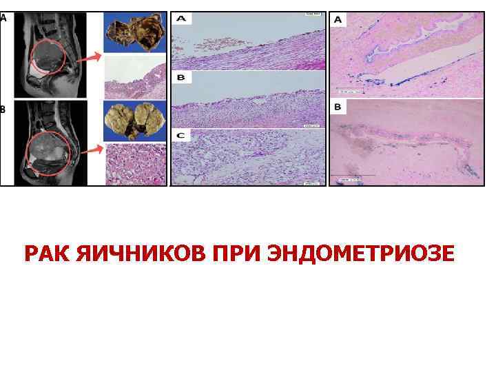 РАК ЯИЧНИКОВ ПРИ ЭНДОМЕТРИОЗЕ 
