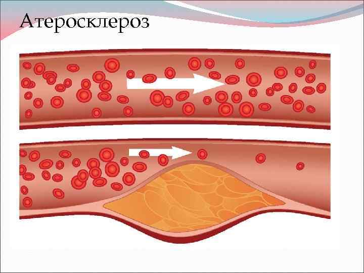 Атеросклероз 