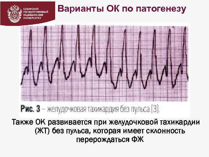 Варианты ОК по патогенезу Также ОК развивается при желудочковой тахикардии (ЖТ) без пульса, которая