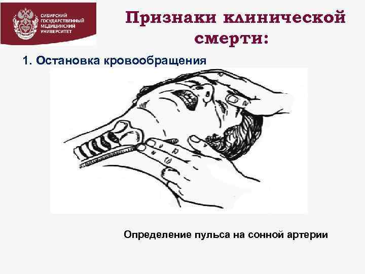 Признаки клинической смерти: 1. Остановка кровообращения Определение пульса на сонной артерии 
