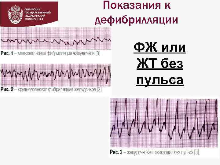 Показания к дефибрилляции ФЖ или ЖТ без пульса 