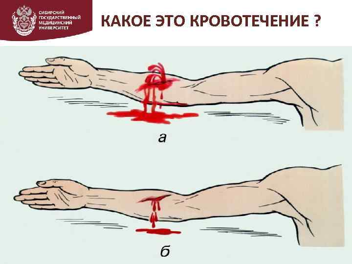 КАКОЕ ЭТО КРОВОТЕЧЕНИЕ ? Блок информации 2 