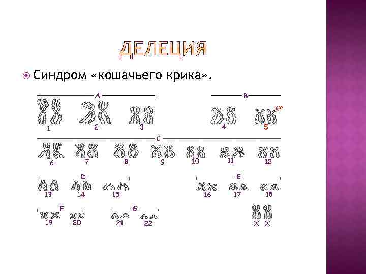 Каким номером на рисунке обозначен тип мутации характерный для больных с синдромом кошачьего крика