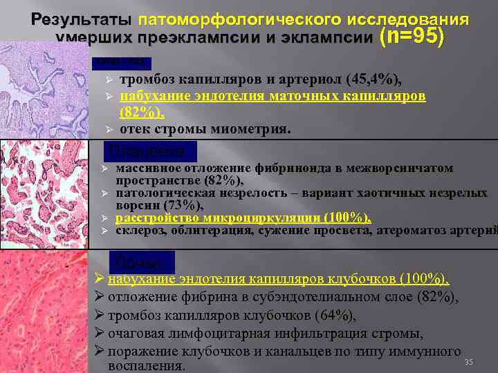Результаты патоморфологического исследования умерших преэклампсии и эклампсии (n=95) Матка Ø Ø Ø тромбоз капилляров