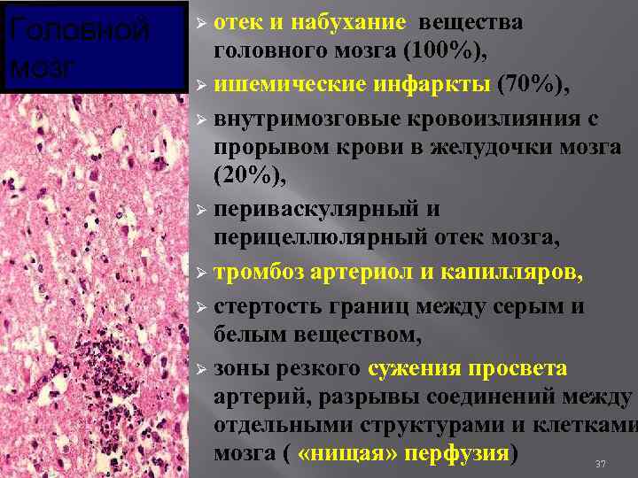 Головной мозг отек и набухание вещества головного мозга (100%), Ø ишемические инфаркты (70%), Ø