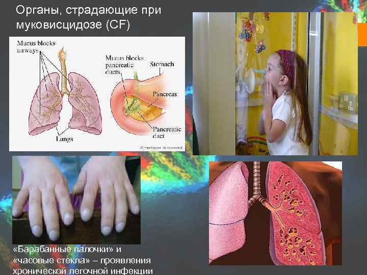 Органы, страдающие при муковисцидозе (СF) «Барабанные палочки» и «часовые стекла» – проявления хронической легочной