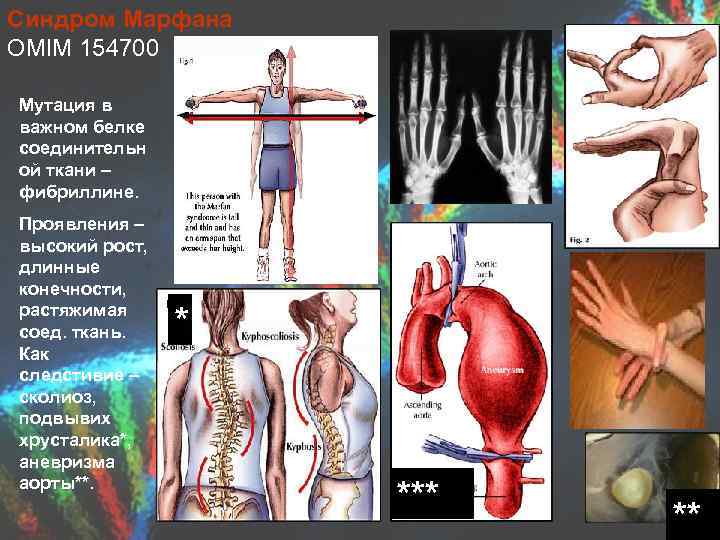 Синдром Марфана OMIM 154700 Мутация в важном белке соединительн ой ткани – фибриллине. Проявления