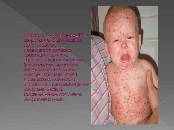 Краснуха – гостра інфекційна хвороба, що спричиняється вірусом краснухи, передається повітрянокрапельним шляхом, характеризується помірною