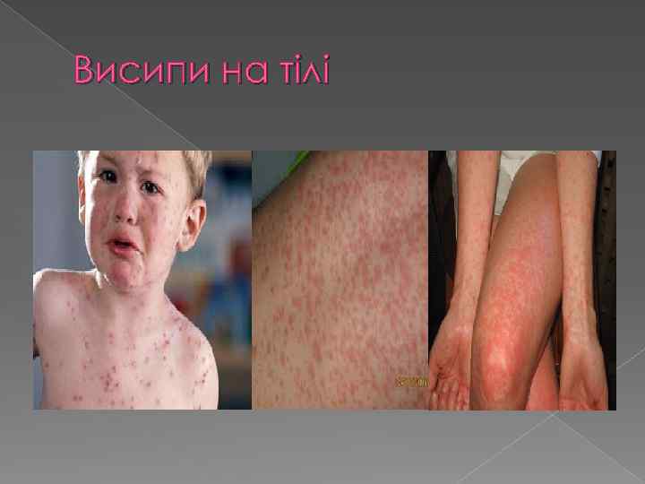 Висипи на тілі 