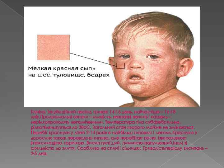 Клініка. Інкубаційний період триває 14 -15 день, найчастіше – 16 -18 днів. Продромальні ознаки