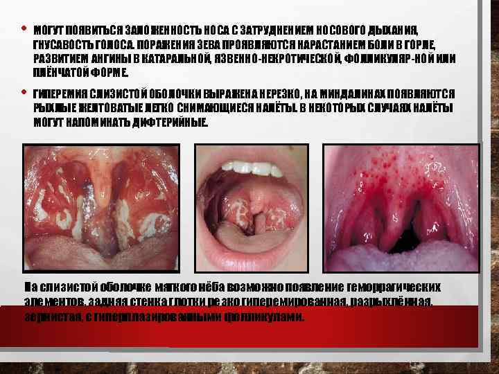  • МОГУТ ПОЯВИТЬСЯ ЗАЛОЖЕННОСТЬ НОСА С ЗАТРУДНЕНИЕМ НОСОВОГО ДЫХАНИЯ, ГНУСАВОСТЬ ГОЛОСА. ПОРАЖЕНИЯ ЗЕВА