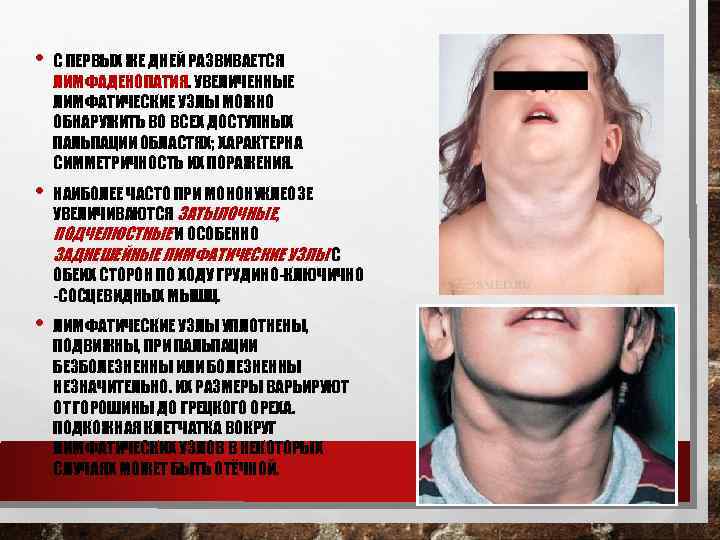  • С ПЕРВЫХ ЖЕ ДНЕЙ РАЗВИВАЕТСЯ ЛИМФАДЕНОПАТИЯ. УВЕЛИЧЕННЫЕ ЛИМФАТИЧЕСКИЕ УЗЛЫ МОЖНО ОБНАРУЖИТЬ ВО