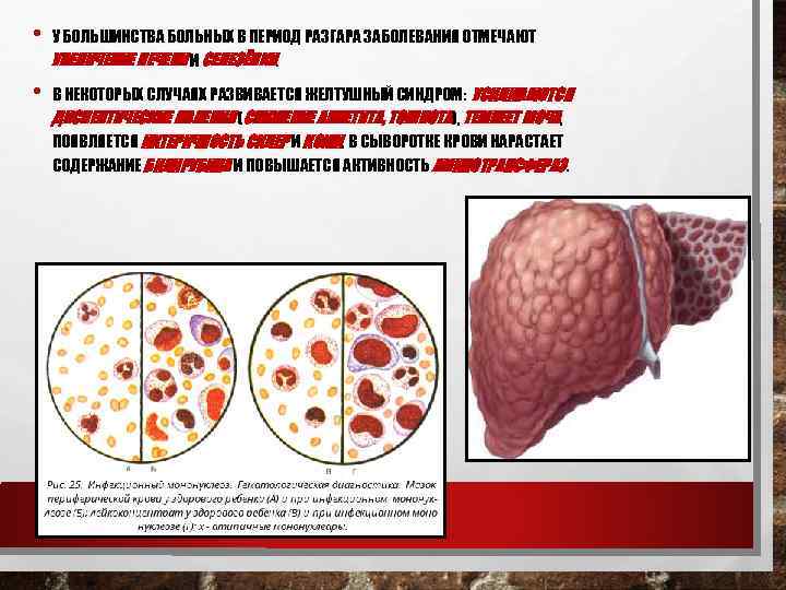  • У БОЛЬШИНСТВА БОЛЬНЫХ В ПЕРИОД РАЗГАРА ЗАБОЛЕВАНИЯ ОТМЕЧАЮТ УВЕЛИЧЕНИЕ ПЕЧЕНИ И СЕЛЕЗЁНКИ.