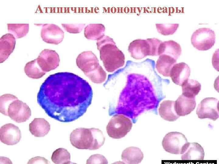 Инфекционный мононуклеоз фото горла